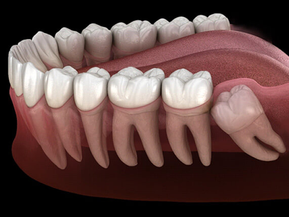 a 3D illustration og an impacted wisdom tooth