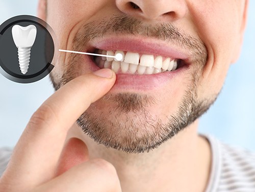 A man revealing his implanted tooth against a light background