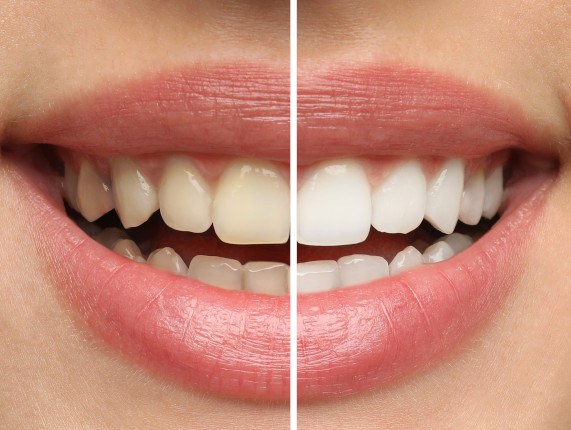 Closeup of patient's smile before and after teeth whitening