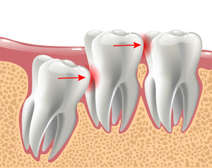 Image of an impacted wisdom tooth