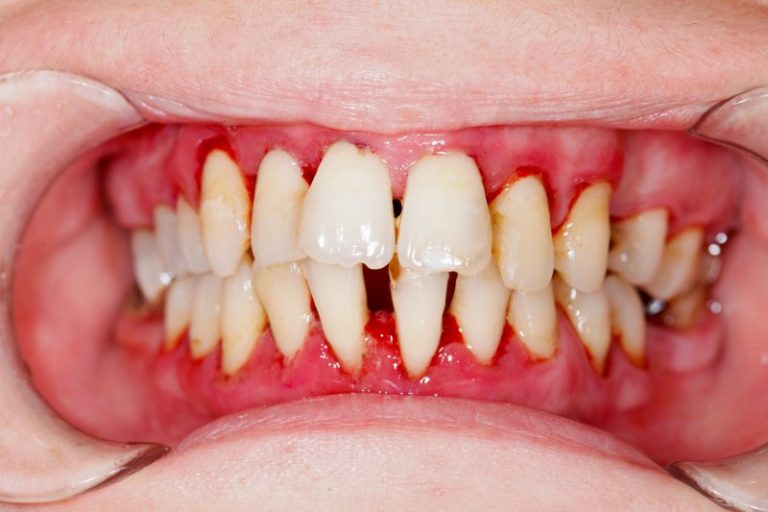Periodontitis Vs Gingivitis Gum Disease West Orange Treatment