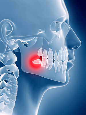 Illustration of impacted wisdom tooth in jawbone