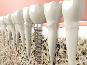 Dental implant in bone tissue