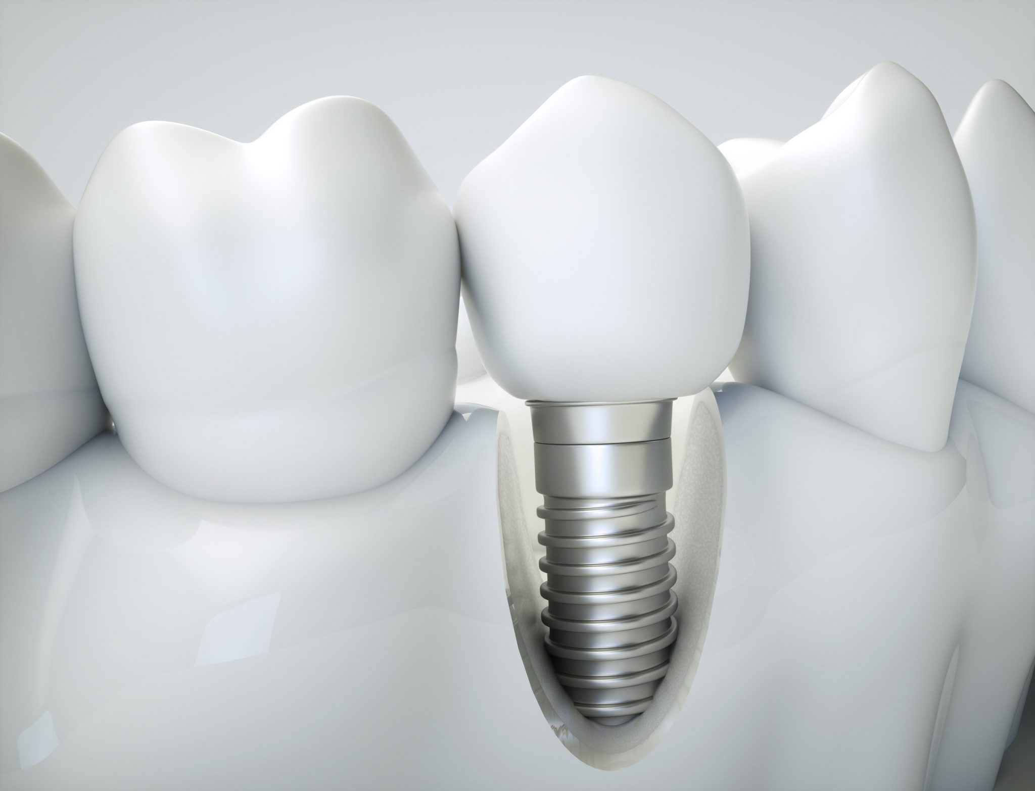 what-to-expect-when-removing-a-failed-dental-implant