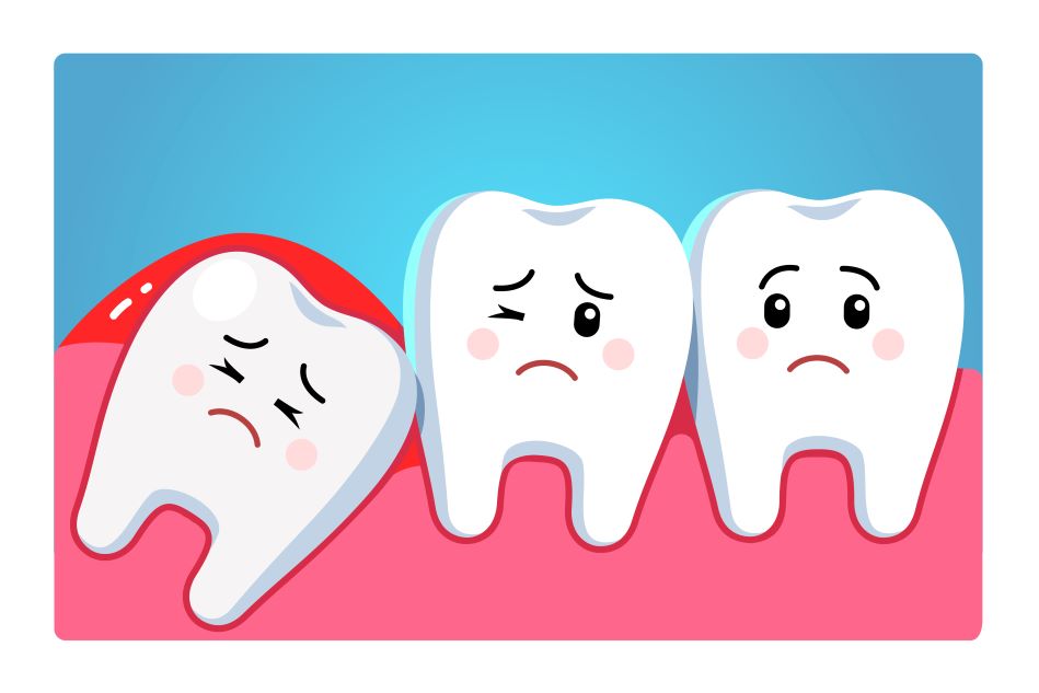 Cartoon drawing of teeth being crowded by a wisdom tooth.